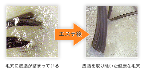 毛穴に皮脂が詰まっている状態が、頭皮エステ後は皮脂を取り除いた健康な毛穴に！